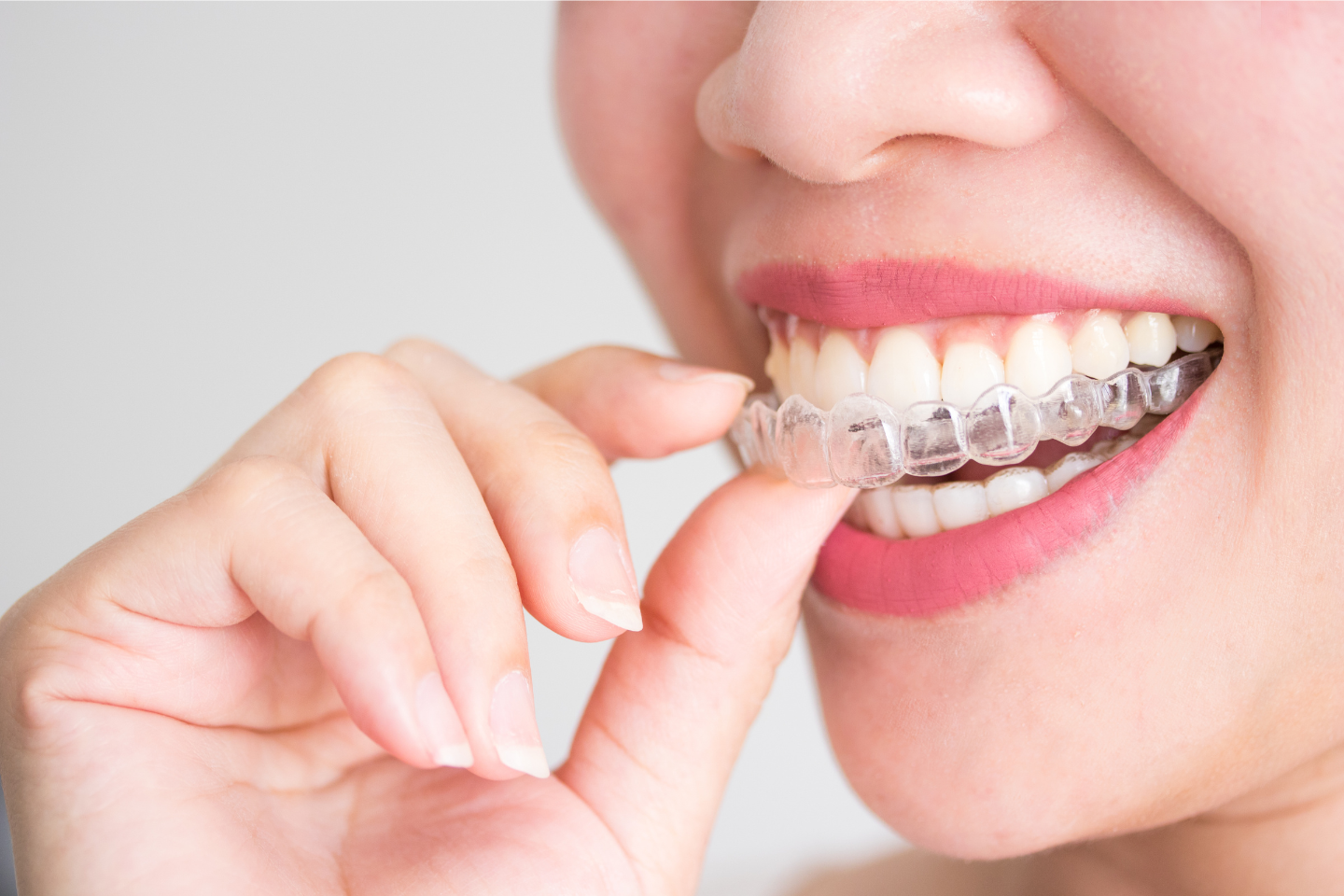 Adult wearing Invisalign clear aligners for teeth straightening at Waltuch & Callan Orthodontics